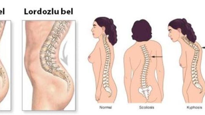 Belinde lordoz olanlarla sporla düzeltele bildiniz mi?