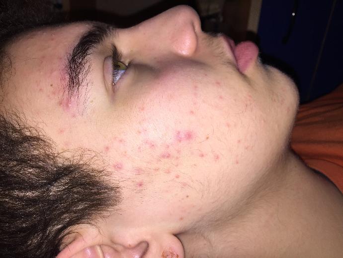 ROACCUTANE VE İZLER (FOTOĞRAFLI)?