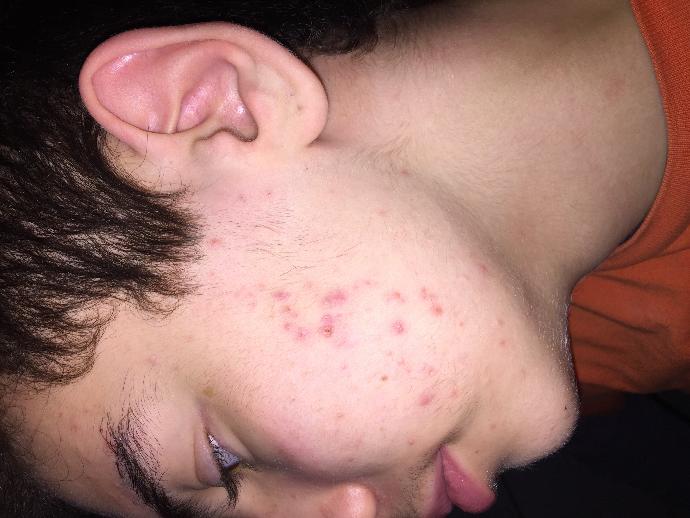 ROACCUTANE VE İZLER (FOTOĞRAFLI)?