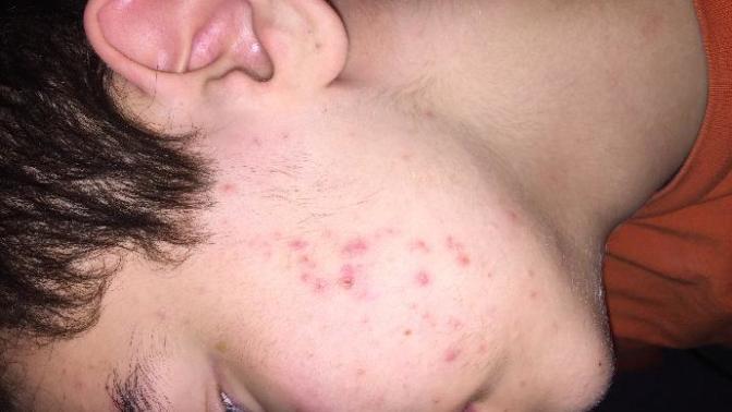 ROACCUTANE VE İZLER (FOTOĞRAFLI)?