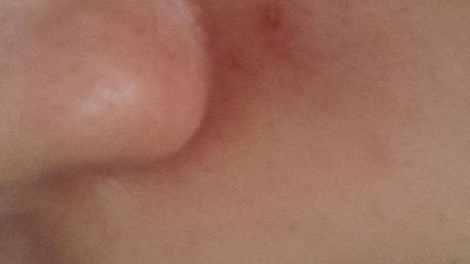 Sivilceye iğne batırdım ve sonuç bu?