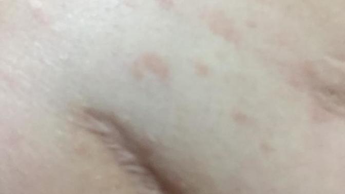 Vücudumdaki yayılan kırmızı lekeler ne olabilir?