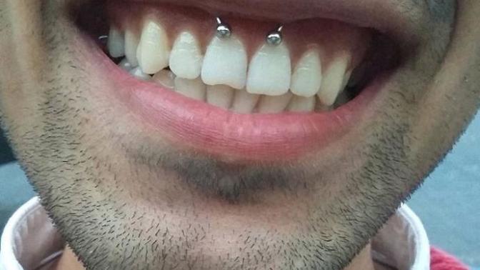Smiley piercing?