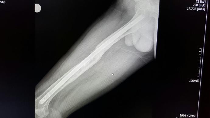 Femur Şaft Kırığı (ASKERLİK) ?