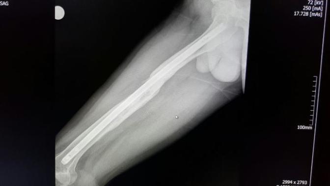 Femur Şaft Kırığı (ASKERLİK) ?