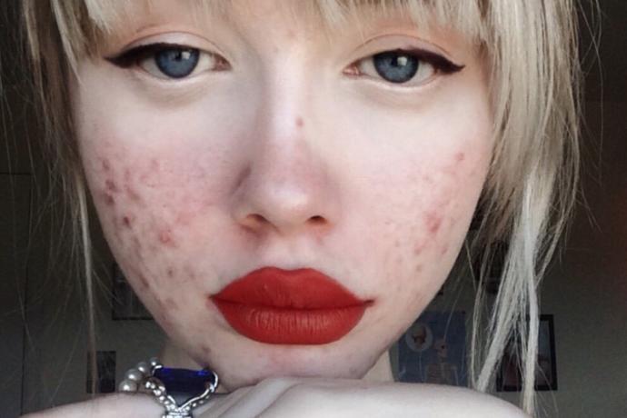 Roaccutane kullandıktan sonra tekrar sivilce çıktı mı?