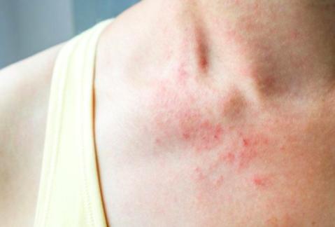 derma neden olur