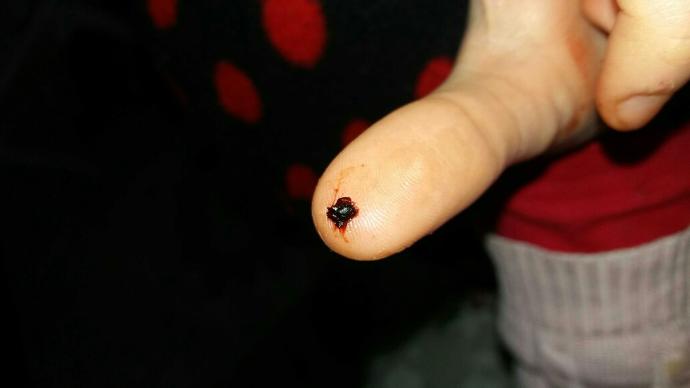 roaccutane hap kullanipta burnu ben kadar kanayan var mi?