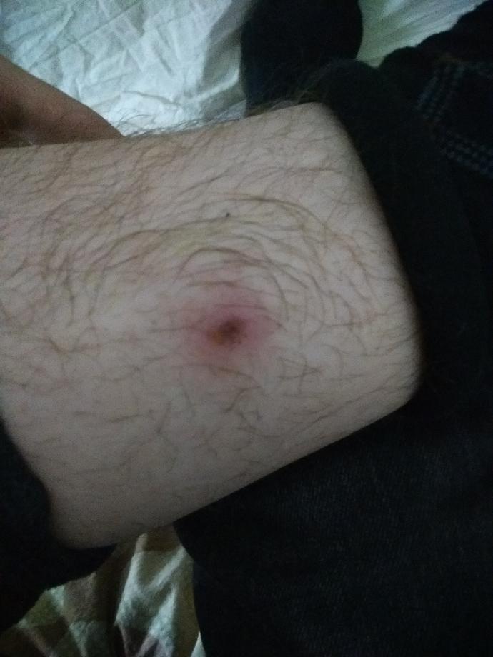 Merhaba arkadaşlar benim bacağında yara çıktı yardım edin bkabuk bağlanıyor?