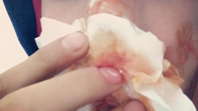 Burnumu kırdım ne yapacağım :( ?