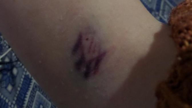 Bir kan vereyim dedim. Başıma gelmeyen kalmadı :( İlk defa kan veriyorum. Bu morluk normal mi?