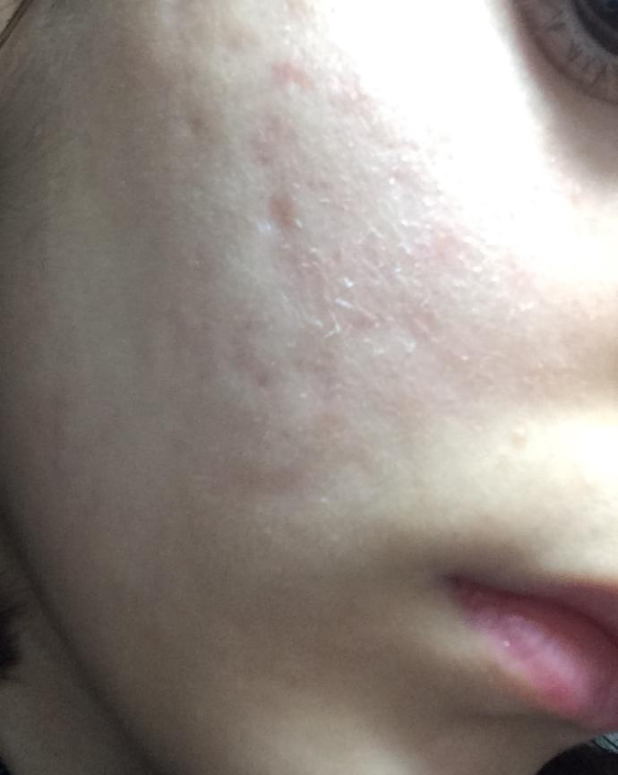 Sivilce izlerim geçer mi (Fotoğraflı)?