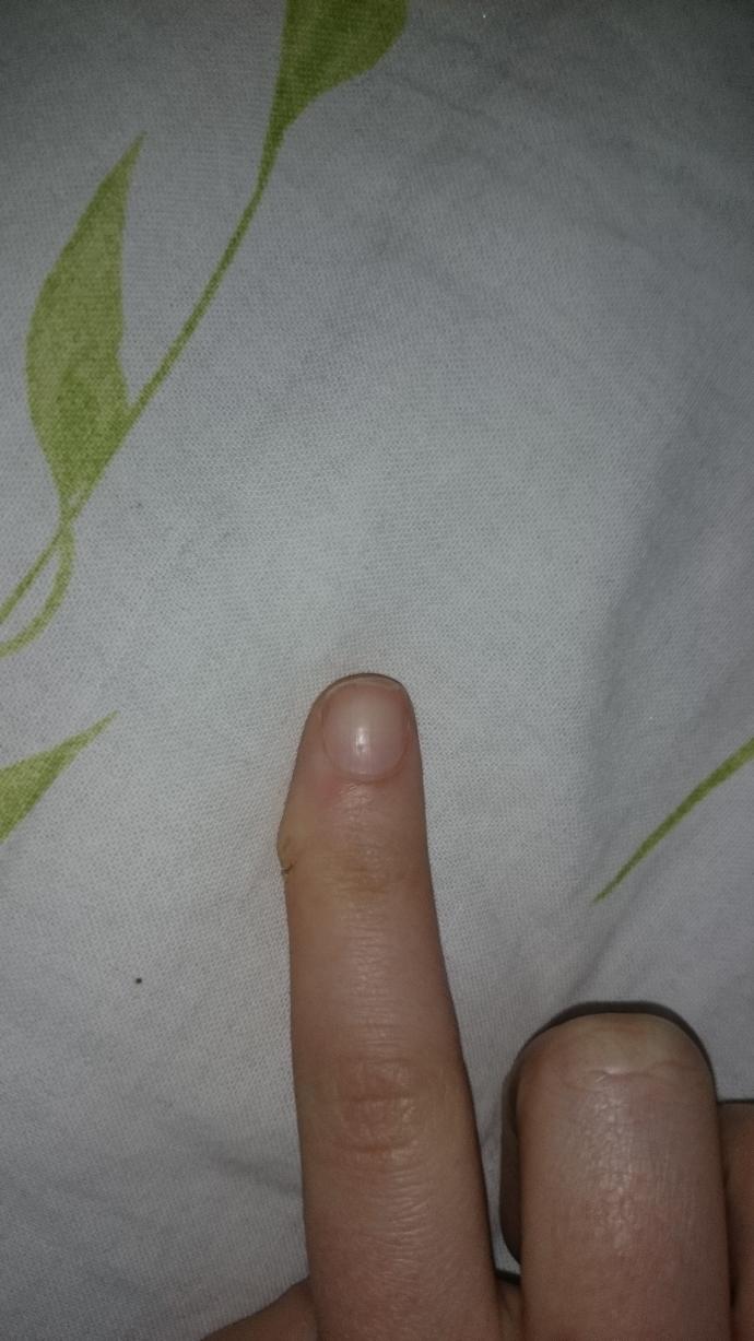 Parmağım camla kesildi şişlik var?