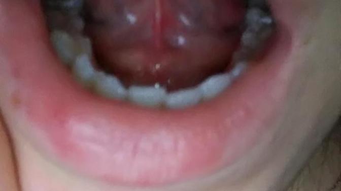 Dilimin altındaki zara kan oturması resimli?