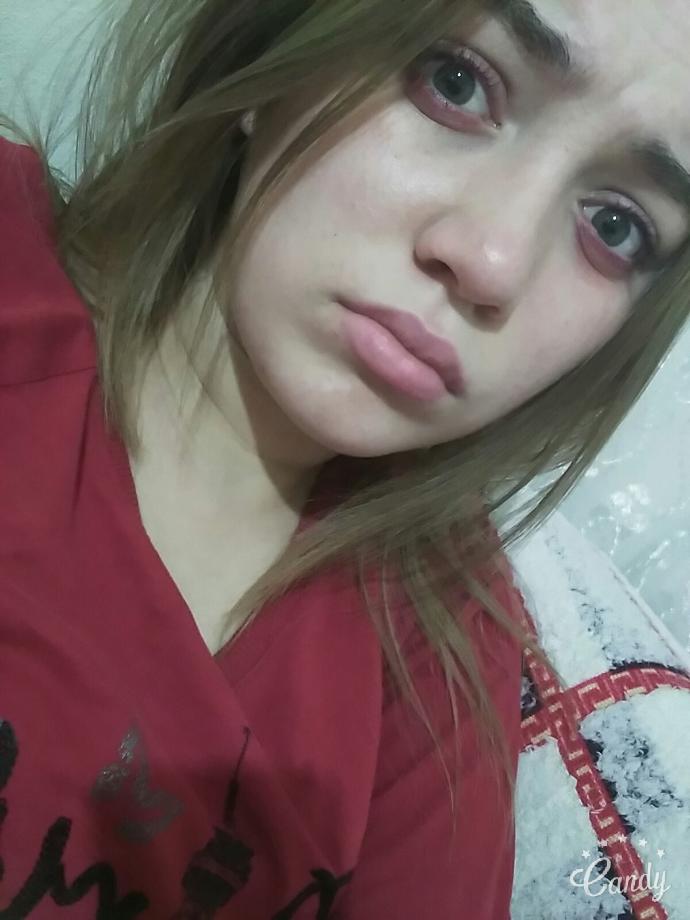Göz altlarim çok mu kötü? Kızarıklık nasıl geçer uyuşturucu kullanmıyorum?