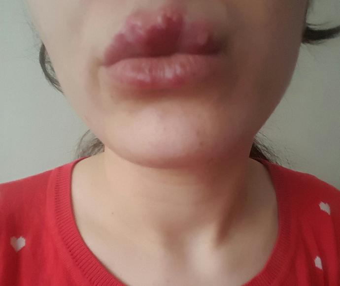 Bu uçuk 3 güne geçermi😭😢?