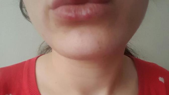 Bu uçuk 3 güne geçer mi?