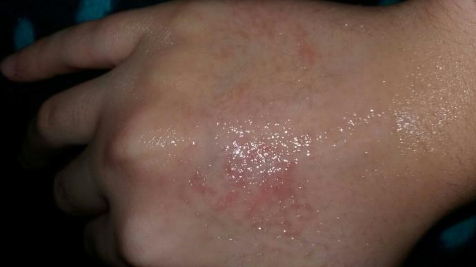 roaccutane hapindan mi kaynaklı acaba ??