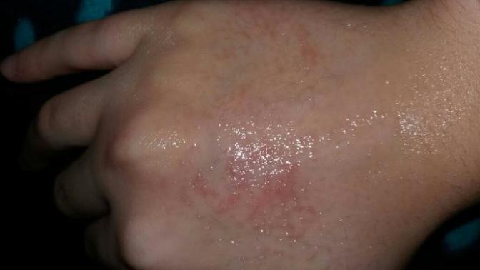 Roaccutane hapindan mi kaynaklı acaba?