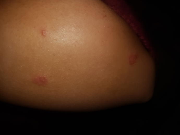 Kolumda bu sekilde yaralar cıktı ne olabilir ya korkuyorum :( detaya bakar misiniz?