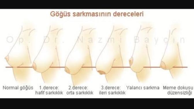 Göğüslerim resimdeki 1. Dereceden sarkık gibi çok mu kötü sizce 90 beden?