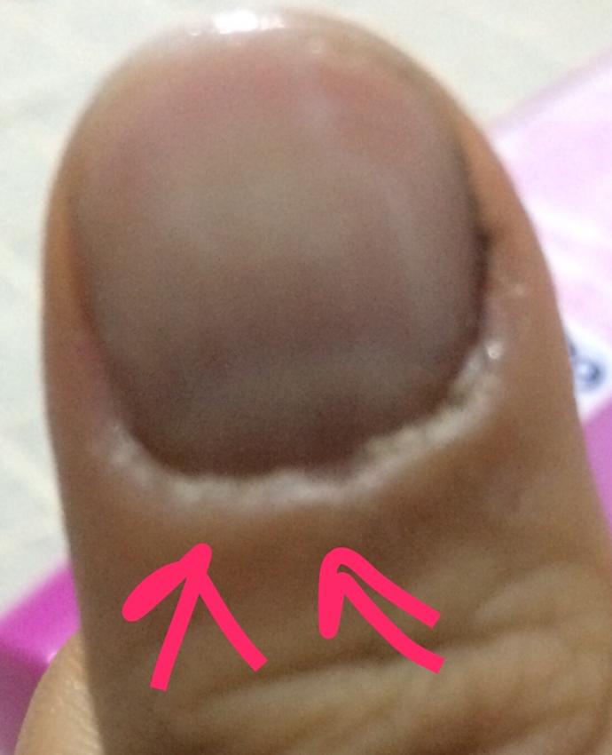 Tırnak etimdeki geçmeyen şişlik ?