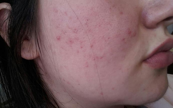 Roaccutane Tedavisi Görmek İstiyorum ?