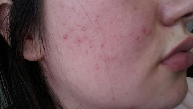 Roaccutane Tedavisi Görmek İstiyorum?