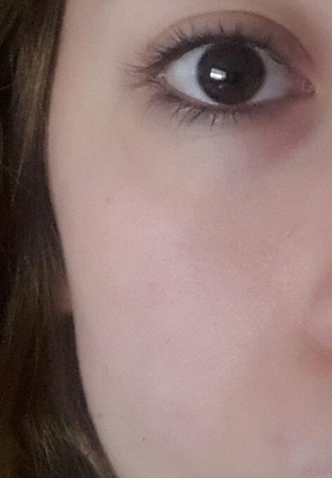Bu ittirse mi sivilce mi?