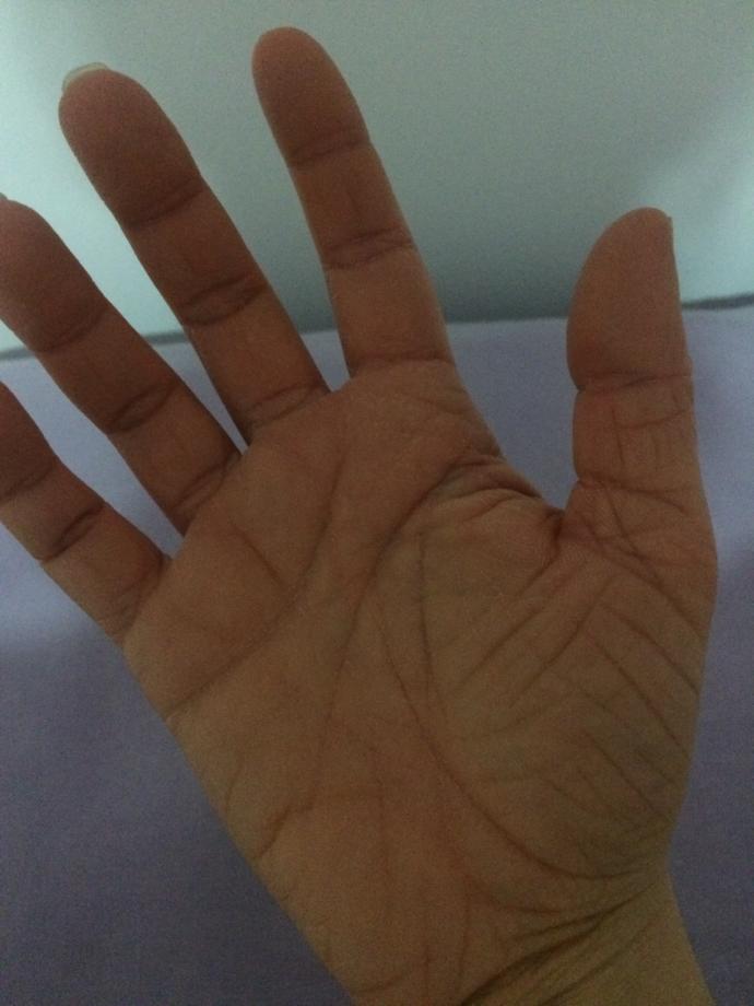 arkadaslar ellerim neden boyle kendimi bildim bileli boyle 18 yasindayim ?