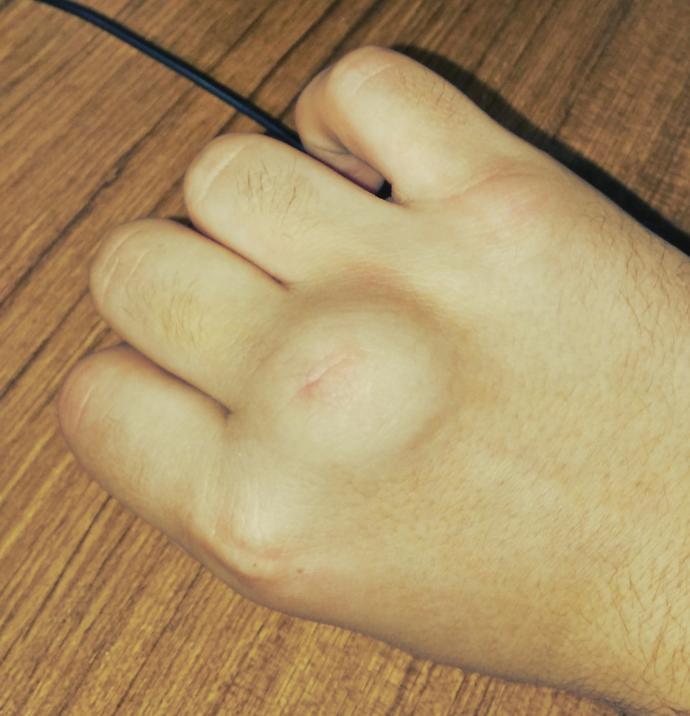 Parçalarcasına yumruk attıktan sonra, parmağım dehşet şişti! fotoğraflı! ne kadar sürede iner bu şişik?