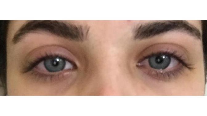 Ağlamaktan şişen gözlere çâre? (Fotoğraflı)?