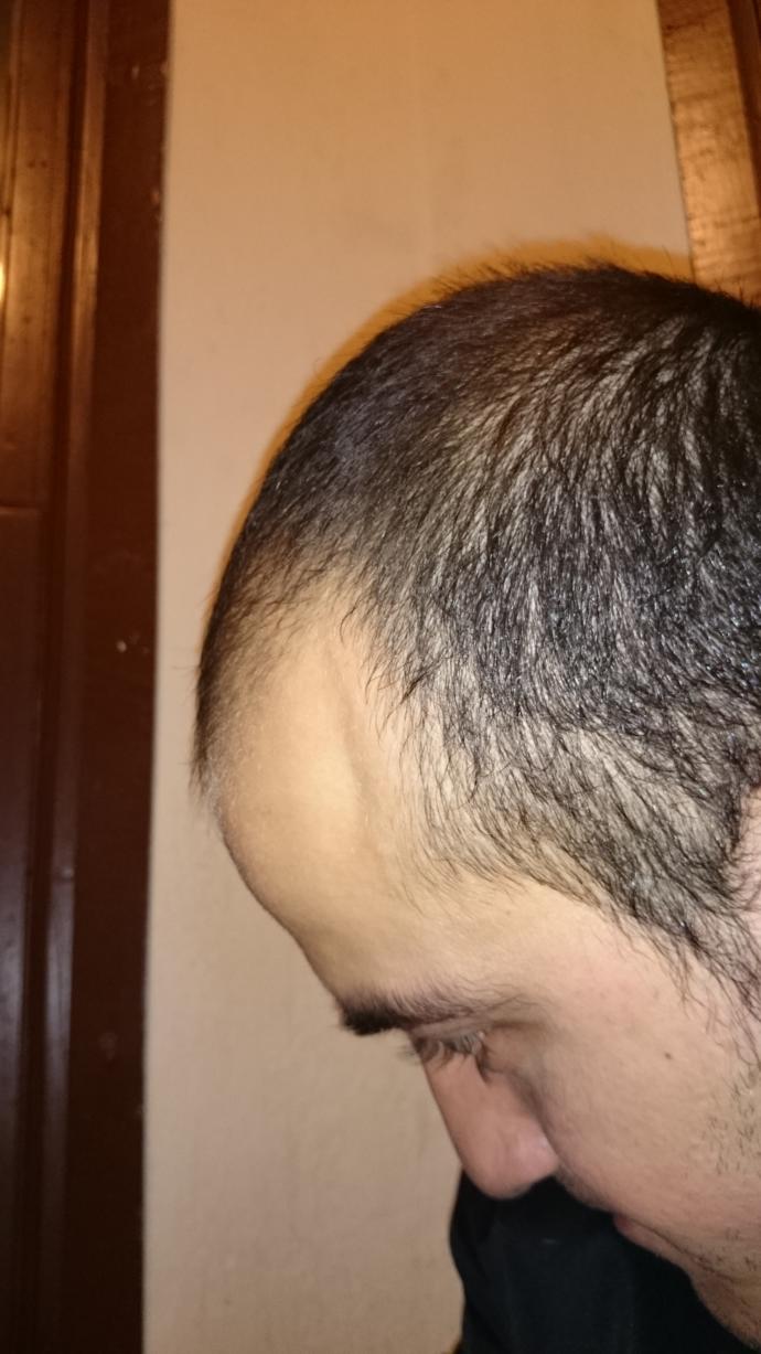 Sizce ben kel miyim? Yaş 25 dökülmeyi durdurdum, bitti. Kenarlara saç ektirmem lazım mı?