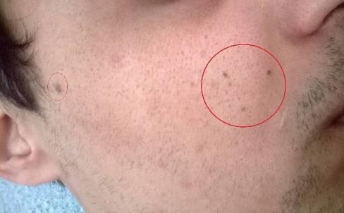 Yüzdeki kahverengi benler alınır mı?
