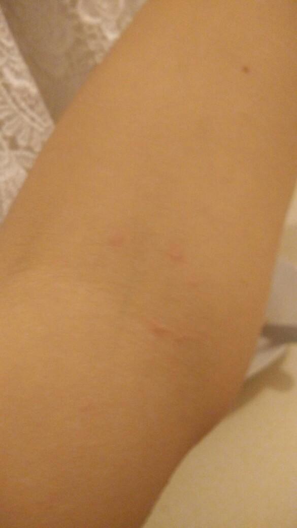 Pire ısırığı olabilir mi ??
