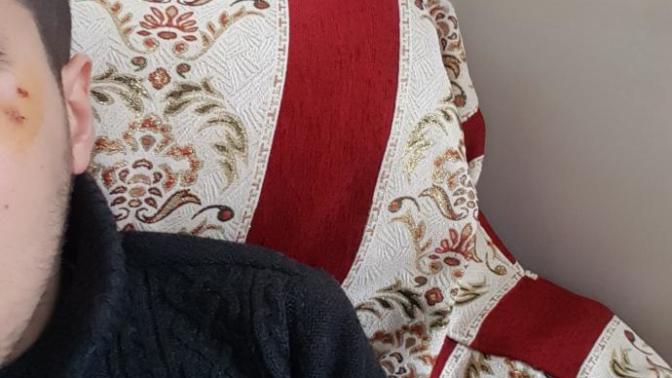 Yüzüme dikiş atıldı bunlar zamanla geçer mi?