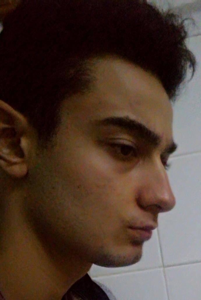 Burnum Büyük mü ameliyata gerek  var mı  ?
