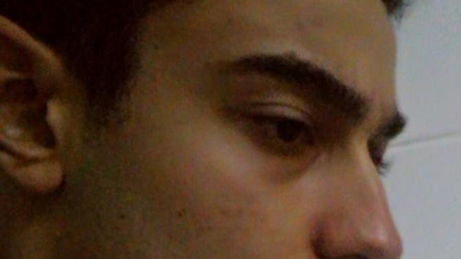 Burnum Büyük mü ameliyata gerek varmi?