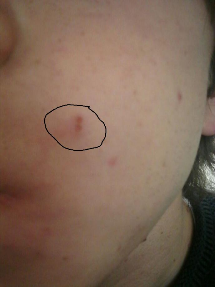Sigara yanığı nasıl geçer ?