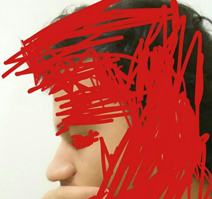 Burnum kız burnu gibi dümdüz kemer eklettirmeli miyim(ss'li) ?