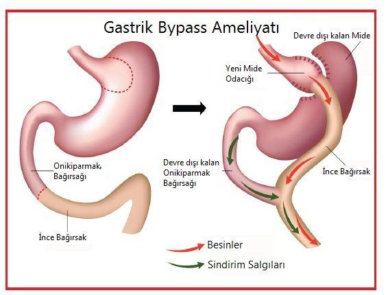 Gastrik Bypass ameliyati olan var mi?