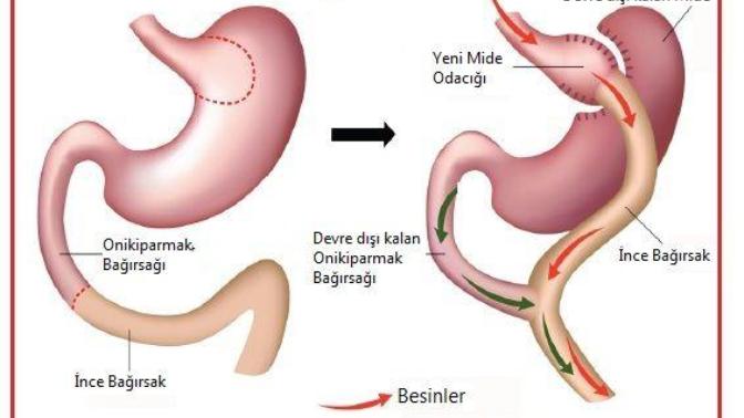 Gastrik Bypass ameliyati olan var mi?