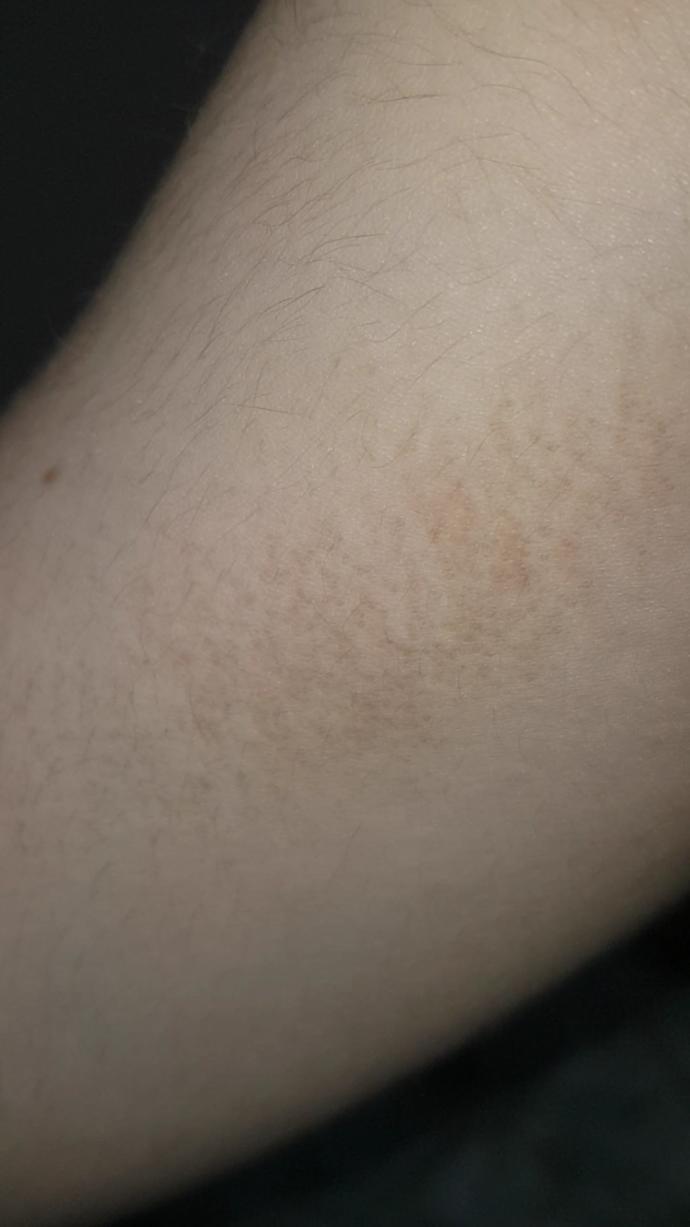 Kolda kararma niçin olur ya resimli?