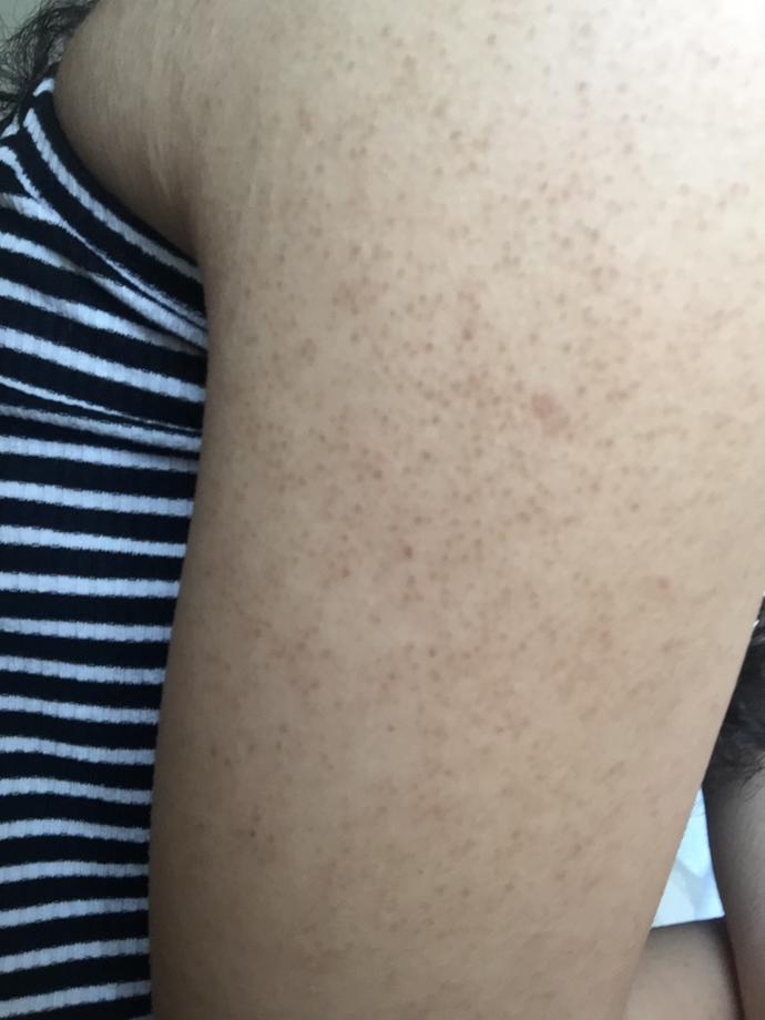 Fotoğraflı/Kollarımda ve sırtımda nokta nokta kahve rengi bir sürü leke var 2 yıldır falan. Nedir sebebi çok takmaya başladım? 