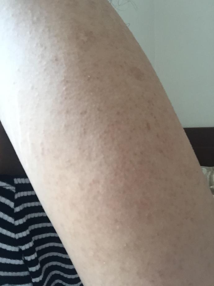 Fotoğraflı/Kollarımda ve sırtımda nokta nokta kahve rengi bir sürü leke var 2 yıldır falan. Nedir sebebi çok takmaya başladım?