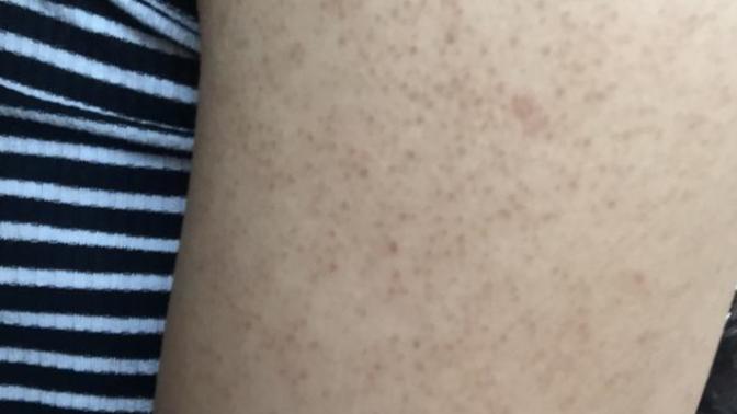 Fotoğraflı/Kollarımda ve sırtımda nokta nokta kahve rengi bir sürü leke var 2 yıldır falan. Nedir sebebi çok takmaya başladım?