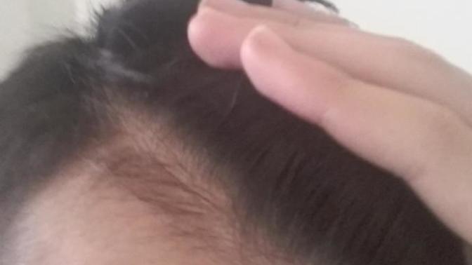Millet sizce bu saç dökülür mü bu resimde sağ şakak bölgesi sol tarafı da var ama sağdaki daha büyük bunun tedavisi  var mı lütfen?