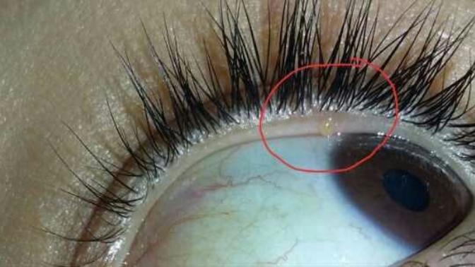 Bu gözümde çıkan şey nedir fotoğraflı?
