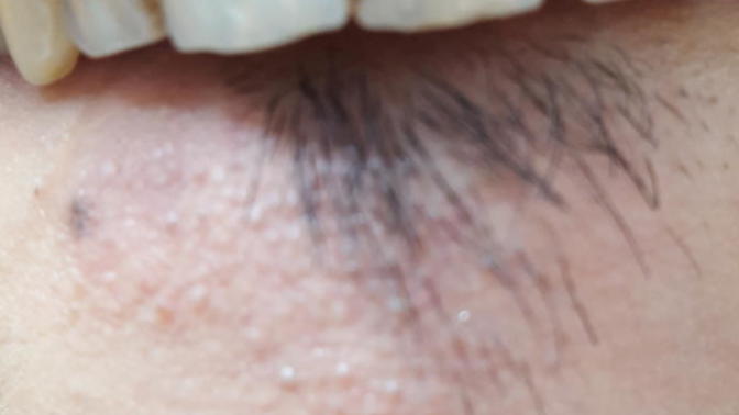 Diş arası çürüğü nasıl temizlenir doktorda?