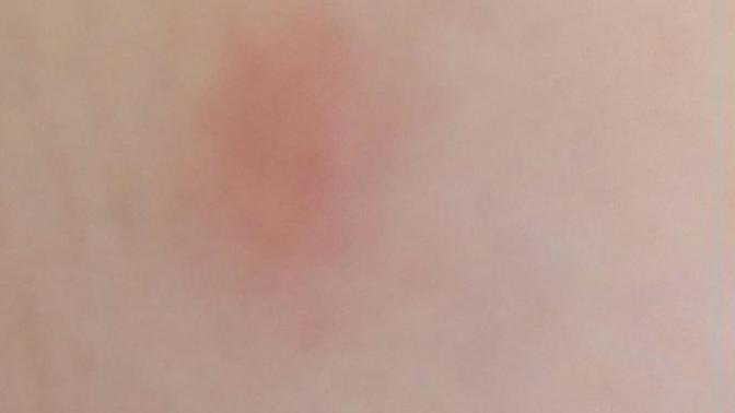 Vucudumda  bir  kizariklik cikti bu onemli bisey midir aids belirtisi boyle olmaz demi?